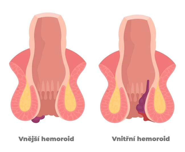 Ilustrace vnějšího a vnitřního hemoroidu