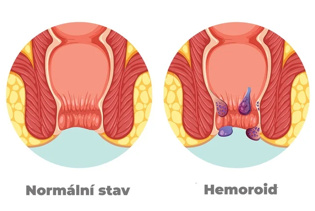 Porovnání zdravého střeva s hemeroidy na ilustraci.
